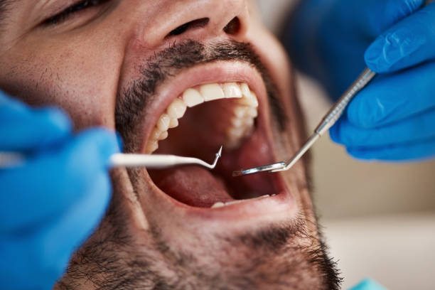 Best Emergency Dental Care for Broken or Chipped Teeth in Alburtis, PA